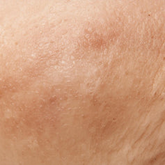 Cellulite