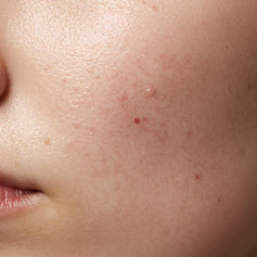 Pigmentation