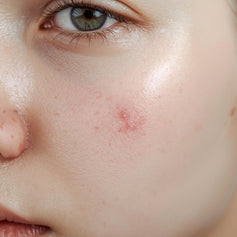 Acne Care